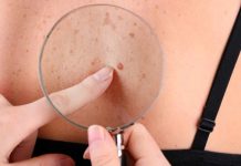 Los casos de cáncer de piel se duplican en Canadá mientras aumenta la exposición al sol