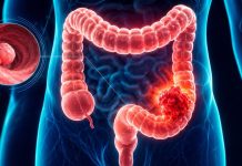 Cómo cambia el cáncer colorrectal cuando aparece antes de los 50 años